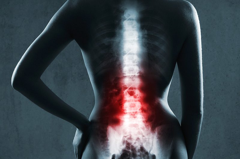 Распространенные травмы спины: переломы позвонков